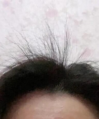 用云南白药的育发液,长了好多碎头发像扫把一样