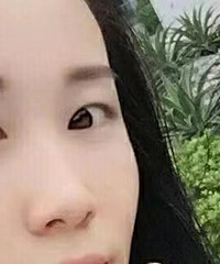 全切双眼皮5个月,分享下如何做好术后护理