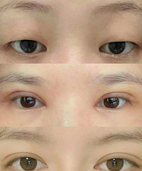 全切双眼皮5个月,分享下如何做好术后护理,才能恢复的超自然
