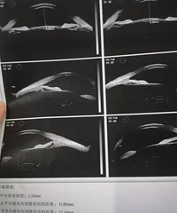 ICL晶体植入,矫正了我的高度近视!终于摘镜了