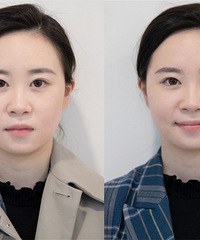 直播解析超声炮全过程!做完之后,我的脸真的立马小了一圈