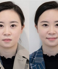 做完超声炮,脸立马就小了一圈