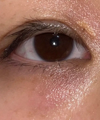 ���ֺ���Ȧ����Ĩ��˪Ҳû�ã�Ӧ��ȥ��ҽ����