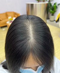 南桥寺中医院脂溢性脱发治疗记录贴,给需要的小伙伴一个参考