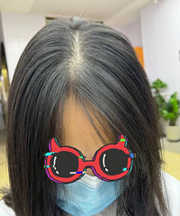 南桥寺中医院脂溢性脱发治疗记录贴,给需要的小伙伴一个参考