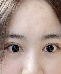 双眼皮修复成功!终于没有了肉条感,看起很自然