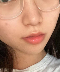 光子嫩肤体验下来真的爱了!去红血丝和痘印效果好