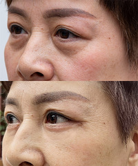 【打探新项目】能修复眼袋,抗眼部衰老的“青春抚平术”