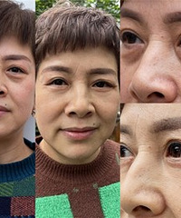 做了眼部抗衰,一下年轻好多岁