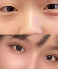 我这双眼皮做成功了么?