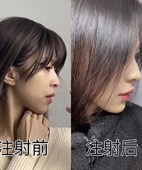 针玻尿酸填充下巴,真的很香!昨晚侧脸精致度直线UP