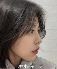 玻尿酸填充下巴真香!现在侧颜精致度直线UP