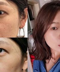 祛掉了生娃后长的雀斑,还有17颗痣