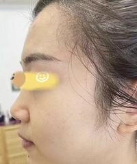 终于舍得花钱抗衰了!超声炮对我这种脸还是多有效的