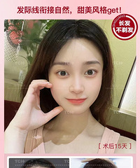 征集!免费体验不剃发植发