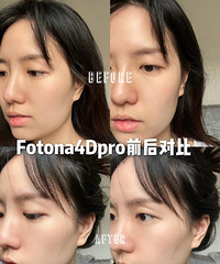 Fotona4D做完一个月,下颌线像刀削的一样