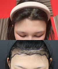 现在植发这么厉害了?直接可以种植长头发!这是我术后立马的变化