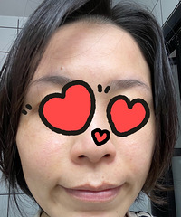 计划每月一次光子+水光针,开贴记录看看效果如何