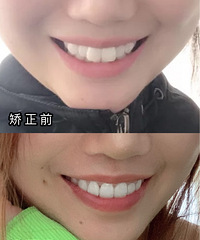 一个爱马仕包换一口牙到底值不值?2年隐适美矫正终于结束啦!
