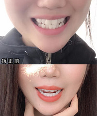 一个爱马仕包换一口牙值不值?2年矫正终于结束啦