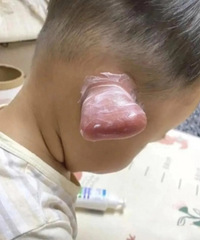 到底经历了啥才变成这样子的?只因被蚊子咬了一口