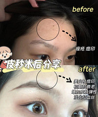做了4次超皮秒,毫无保留的经验分享!想要祛斑的姐妹来看