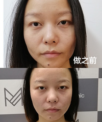 98元的黑金超光子水光针简直太香了~