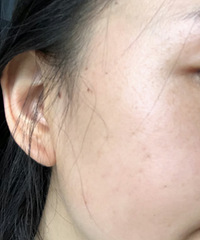 光子嫩肤坚持做了大半年,原相机记录我的皮肤变化