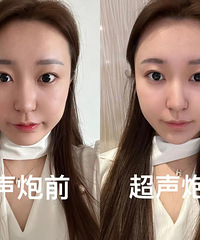 我发现肉肉脸真的很适合做超声炮啊, 这个钱没白花!