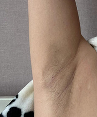 腋下很黑怎么办呀?美白身体乳一点效果也没有..