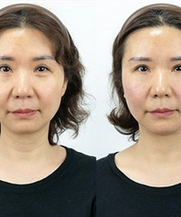 热玛吉也能无痛了?做一次变化好明显