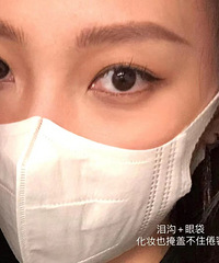 终于向黑眼圈和泪沟下手了!效果我反手就是一个赞