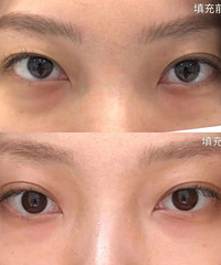 终于向我的黑眼圈和泪沟下手了!这效果我反手就是一个赞