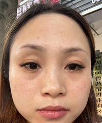 黑眼圈针是撒子黑科技!即刻效果就惊艳到了我