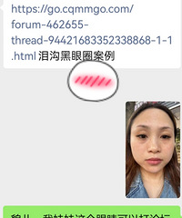 黑眼圈针是撒子黑科技!即刻效果就惊艳到了我