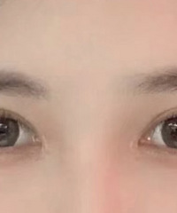 都说我做了双眼皮手术后,像变了一个人!所以找对好医生很重要