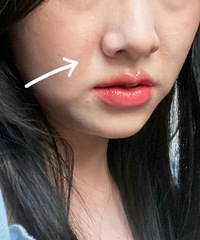 脸上肉多且松且垂,现在好焦虑,真诚提问要如何改善?