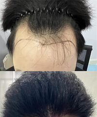 植发拯救了我快秃没了的发际线!过程挺轻松,感觉自己现在好帅