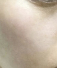 做了这个祛斑套餐2次,我长了N年的斑都几乎快没有了,强烈推荐