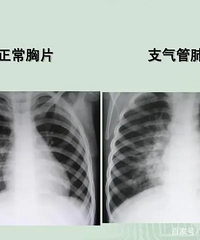看似普通的扁桃炎变成肺炎住院8天