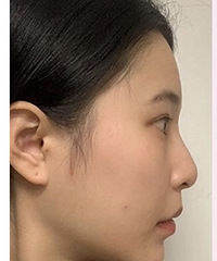 找了审美在线的医生做鼻子,越来越爱自己的脸了