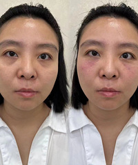 半信半疑的去打了针,效果还可以!发帖还有红包可以拿