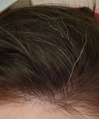 突然就开始长白头发,是不是除了染头发就没的办法了?
