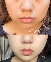 瘦脸针10天啦,来分享一下真实感受,朋友们都说我脸瘦了!