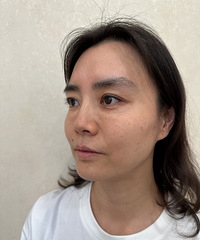 !10分钟就改善了我的泪沟和黑眼圈,医美太香了