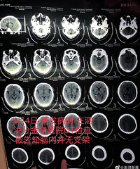 患者脑梗去世,医生隐瞒未成功植入脑血管支架