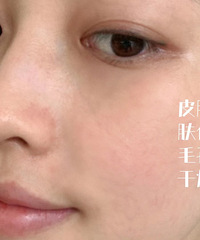 水光针初体验 , 皮肤亮了几个度!给在观望的姐妹们一个参考