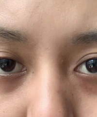 天生的黑眼圈直接没眼看,试了很多方法了没有效果,怎么办呀