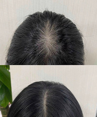 养发我的认真的!内服+外用坚持一年,发缝都不见了