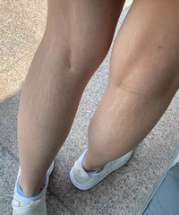 你们的腿上有这种纹吗,好难看!都不敢穿短裤短裙出门了